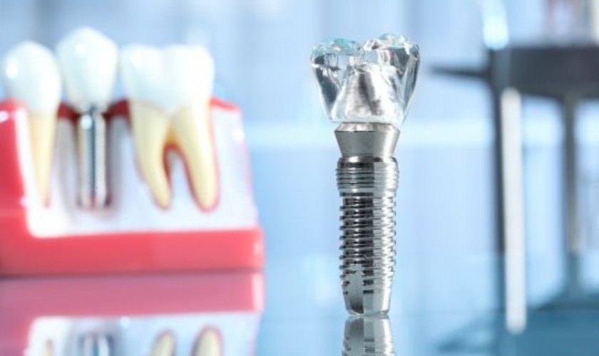 3 Easy Steps To Dental Implant Freedom