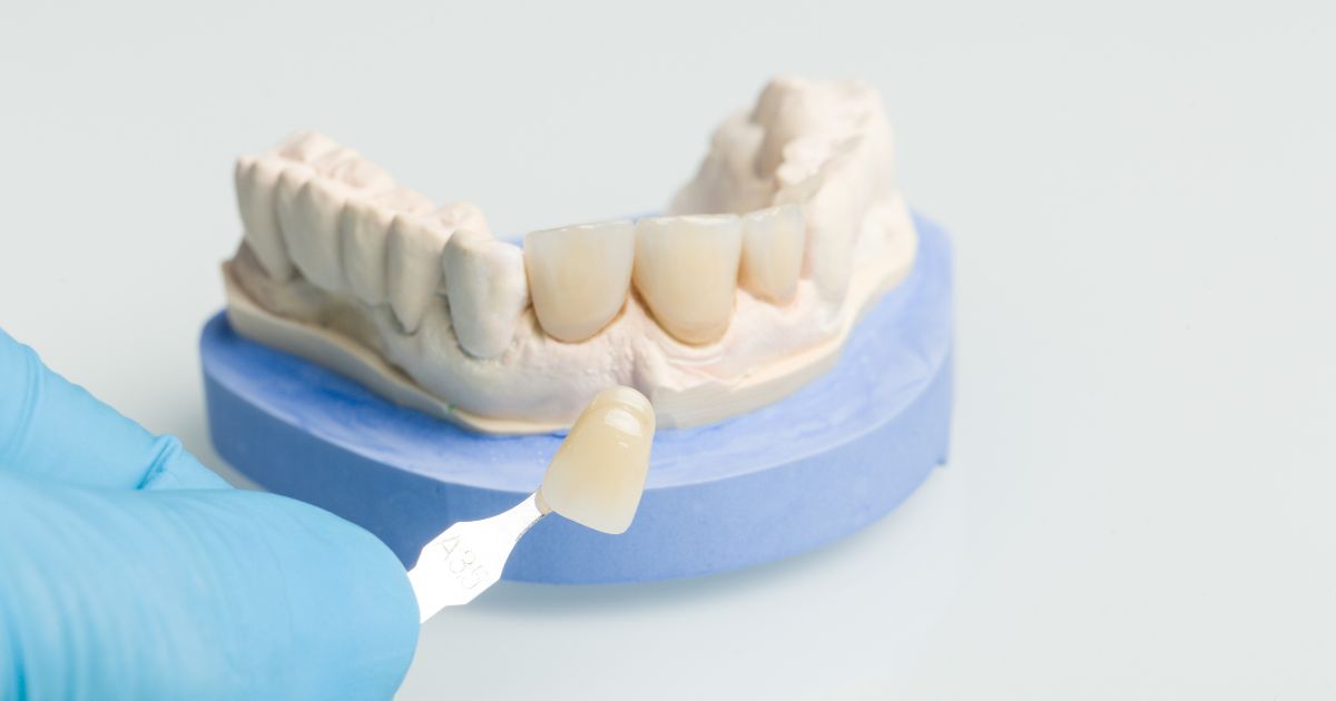 What to Expect from Your Dental Crown Procedure?